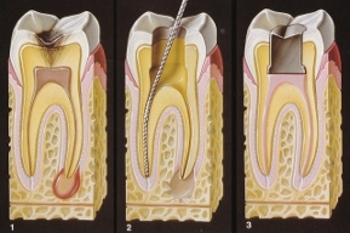 Endodonzia